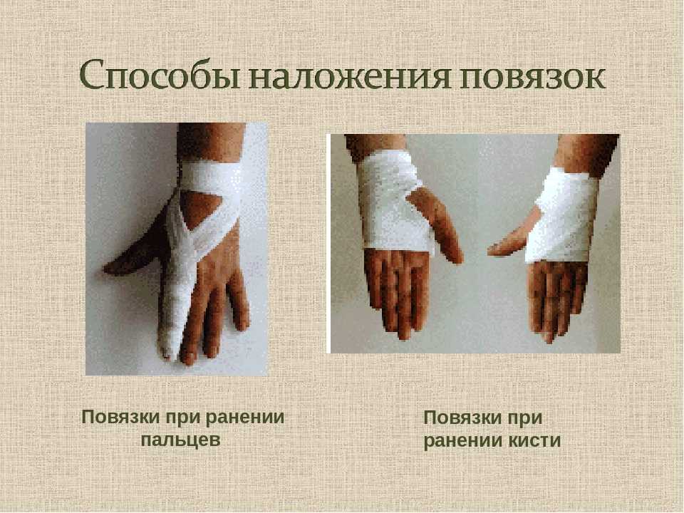 Способы наложения повязок при кровотечении. Повязка при ранении пальца. Наложение повязки при ранении. Повязка при ранении кисти. Перевязка руки.